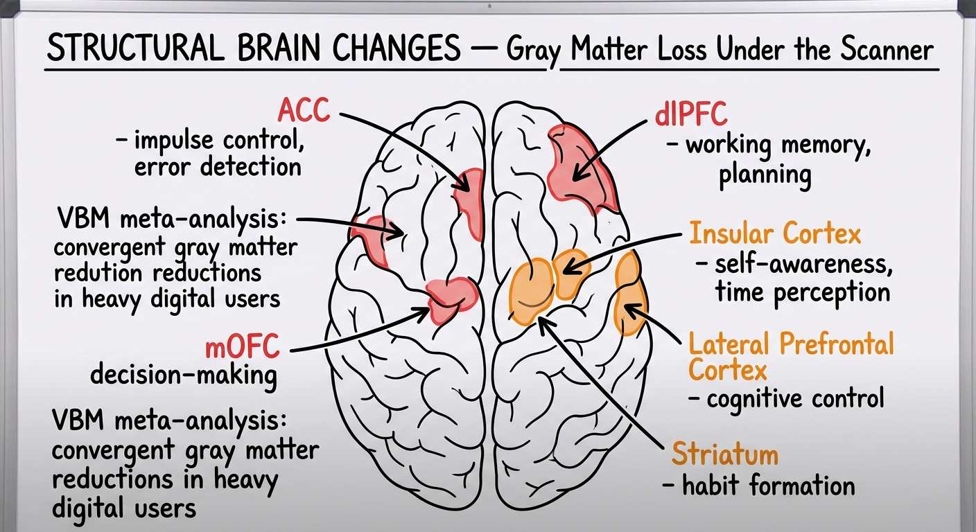 Whiteboard diagram showing top-down brain view with six regions of gray matter loss highlighted: ACC, dlPFC, mOFC in red (high impact), and insular cortex, lateral PFC, striatum in orange (medium impact)